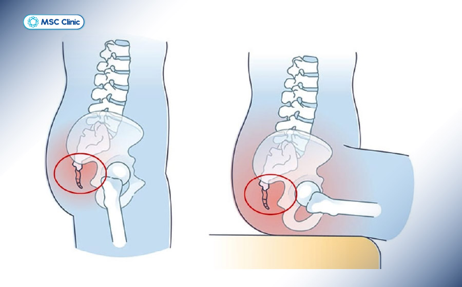 Cơn đau xương cụt tăng lên khi ngồi xuống Cơn đau xương cụt tăng lên khi ngồi xuống