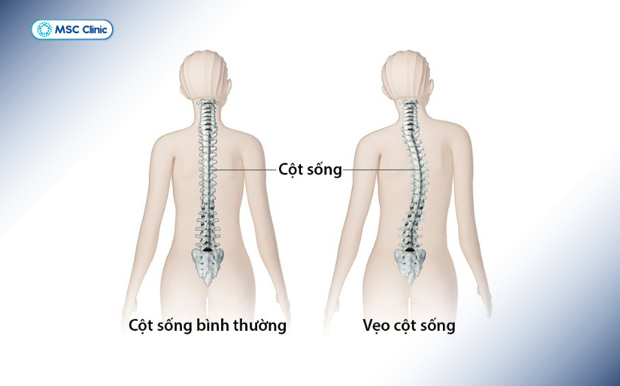 Cong vẹo cột sống không chỉ ảnh hưởng tới thẩm mỹ mà còn tiềm ẩn nhiều hệ lụy