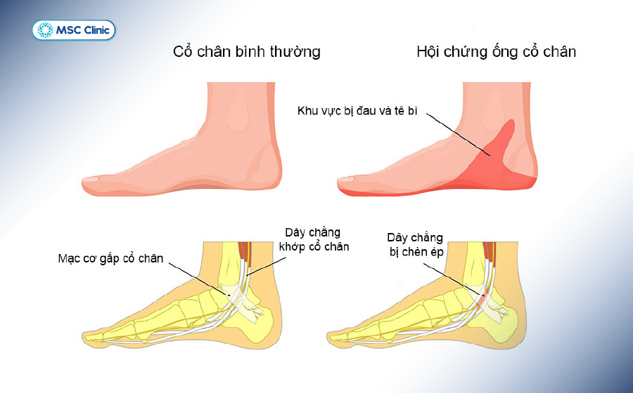 Đau hoặc khó chịu vùng cổ chân trong và gan bàn chân là triệu chứng thường gặp của hội chứng ống cổ chân Đau hoặc khó chịu vùng cổ chân trong và gan bàn chân là triệu chứng thường gặp của hội chứng ống cổ chân