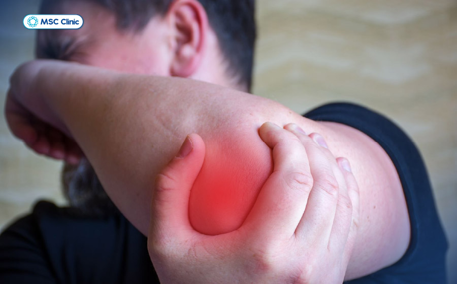 Đau khuỷu tay có thể kèm sưng, đỏ nếu do viêm cấp tính
