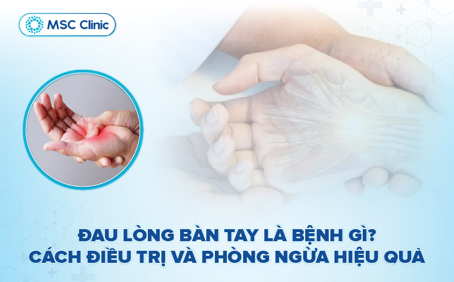 Đau lòng bàn tay là bệnh gì? Nguyên nhân và cách cải thiện