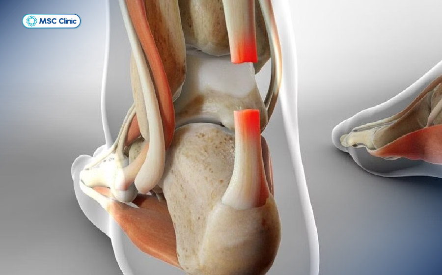 Đây là dạng chấn thương gót chân Achilles nguy hiểm nhất, có thể ảnh hưởng lâu dài đến khả năng đi lại Đây là dạng chấn thương gót chân Achilles nguy hiểm nhất, có thể ảnh hưởng lâu dài đến khả năng đi lại