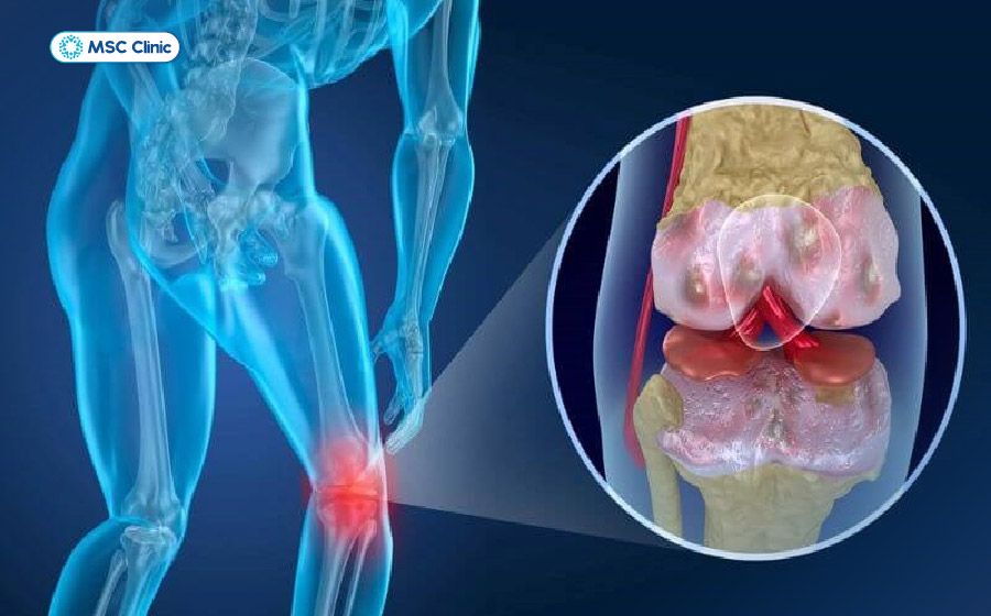 Dịch khớp tích tụ quá mức trong khoang khớp gối gây tràn dịch khớp