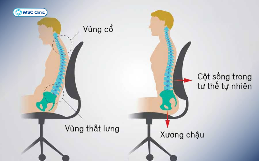Duy trì tư thế đúng hàng ngày sẽ giúp ngăn ngừa nguy cơ cong vẹo cột sống