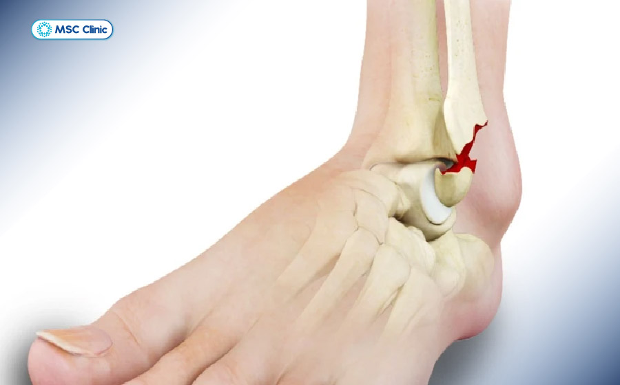 Gãy mắt cá chân là chấn thương chân phổ biến Gãy mắt cá chân là chấn thương chân phổ biến