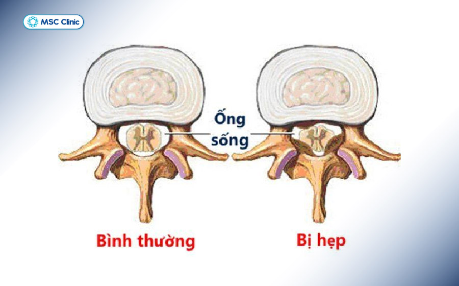 Hẹp ống sống làm giảm không gian dành cho tủy sống và các rễ thần kinh
