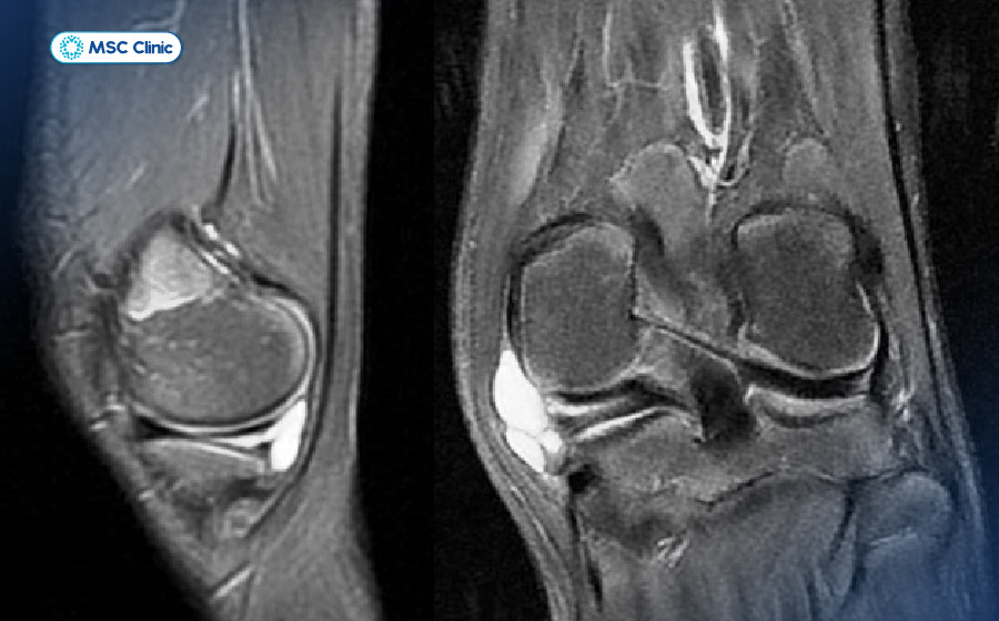 Hình ảnh chụp MRI khớp gối. Việc lựa chọn phương pháp phù hợp phụ thuộc vào mục tiêu chẩn đoán của bác sĩ Hình ảnh chụp MRI khớp gối. Việc lựa chọn phương pháp phù hợp phụ thuộc vào mục tiêu chẩn đoán của bác sĩ