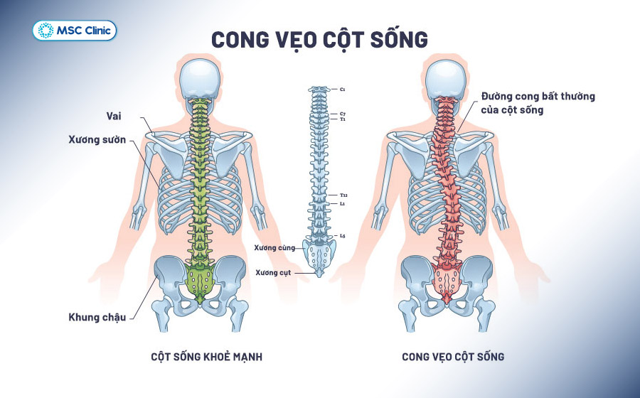 Hình ảnh cột sống cong vẹo so với cột sống bình thường
