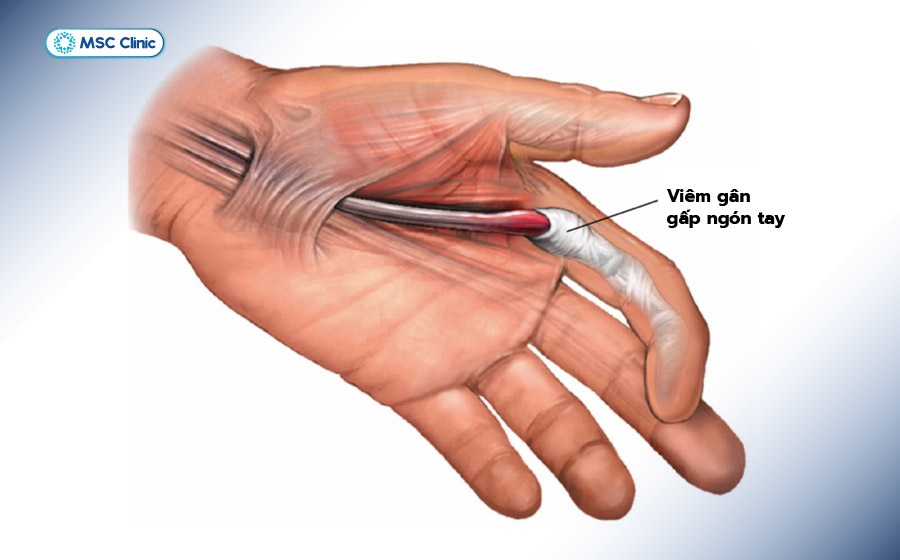 Hình ảnh gân gấp ngón tay bị viêm gây sưng đỏ, hạn chế cử động