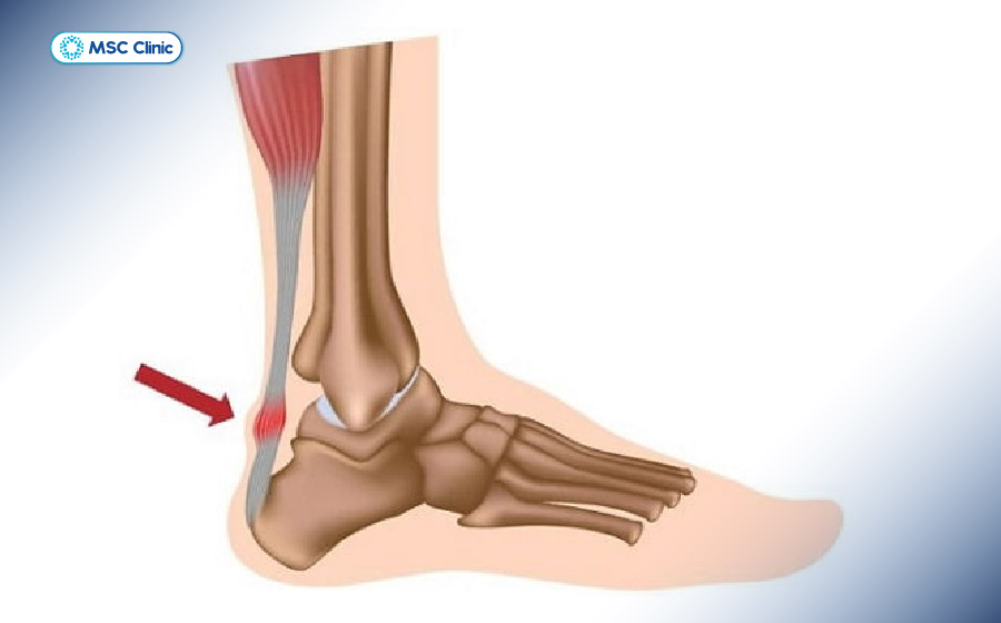 Hình ảnh minh họa gân gót Achilles bị tổn thương Hình ảnh minh họa gân gót Achilles bị tổn thương