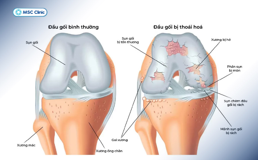 Hình ảnh so sánh khớp gối bình thường và khớp gối bị thoái hóa