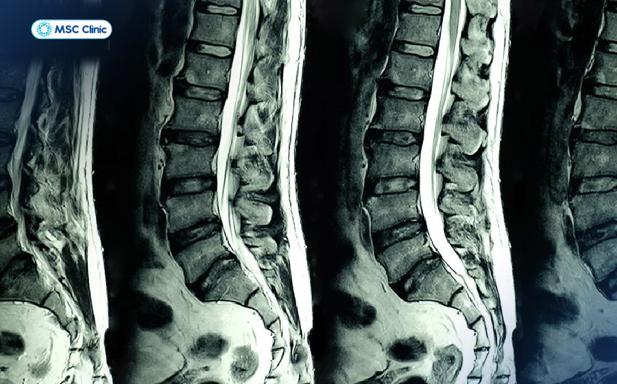 Hình chụp MRI cột sống thắt lưng cho phép quan sát chi tiết tình trạng đĩa đệm, dây thần kinh và các mô mềm xung quanh Hình chụp MRI cột sống thắt lưng cho phép quan sát chi tiết tình trạng đĩa đệm, dây thần kinh và các mô mềm xung quanh