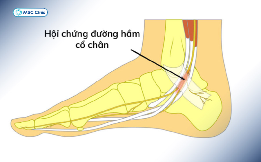 Hội chứng ống cổ chân là tình trạng dây thần kinh chày bị chèn ép tại vùng cổ chân, gây đau, tê hoặc nóng rát bàn chân Hội chứng ống cổ chân là tình trạng dây thần kinh chày bị chèn ép tại vùng cổ chân, gây đau, tê hoặc nóng rát bàn chân