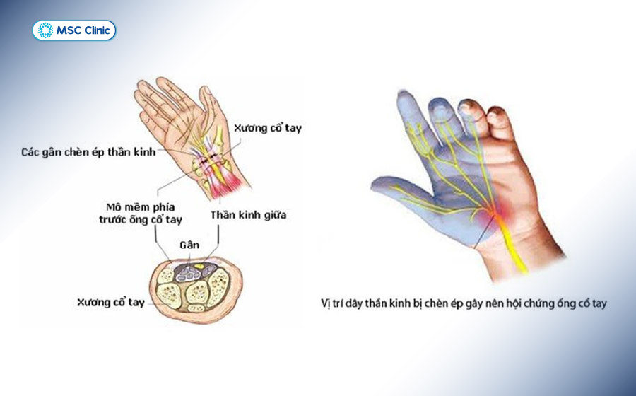 Hội chứng ống cổ tay là nguyên nhân phổ biến gây tê ngón cái, ngón trỏ và ngón giữa