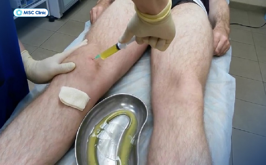 Hút dịch khớp giúp giảm áp lực trong khớp và hỗ trợ chẩn đoán nhưng không phải là phương pháp điều trị nguyên nhân gây tràn dịch 