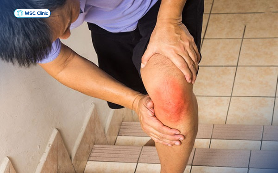 Khớp gối là vị trí dễ bị viêm dây chằng nhất do phải chịu phần lớn trọng lượng cơ thể khi đi lại, chạy hoặc leo cầu thang