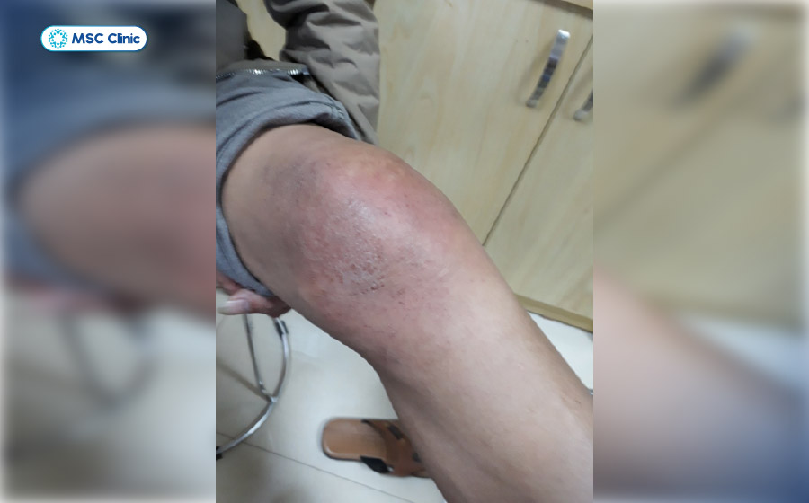 Khớp gối sưng nề, bầm tím hoặc tụ máu có thể xuất hiện sau khi xương bánh chè bị tổn thương 