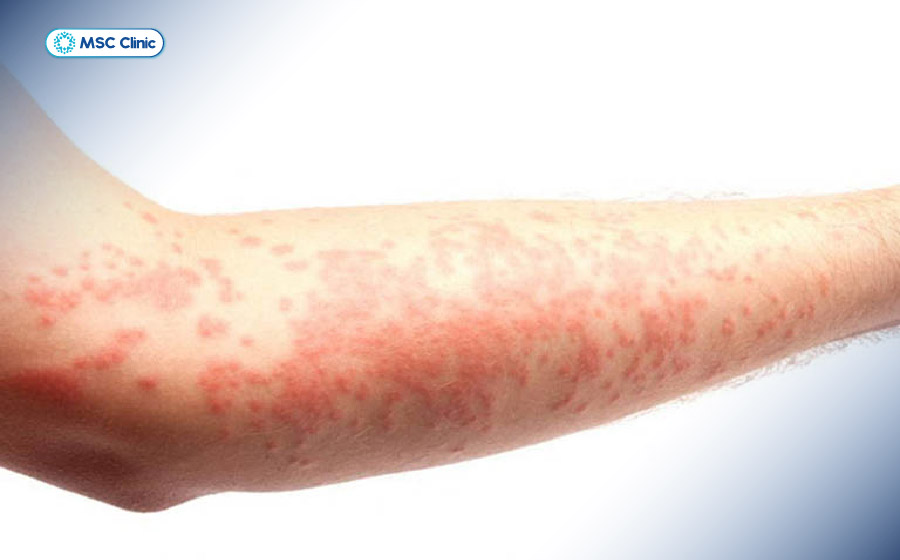 Lupus ban đỏ hệ thống có thể ảnh hưởng tới cơ bắp tay