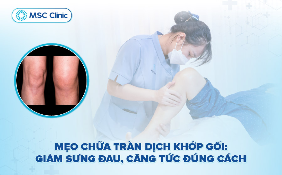 Mẹo chữa tràn dịch khớp gối giảm đau hiệu quả, nhanh chóng