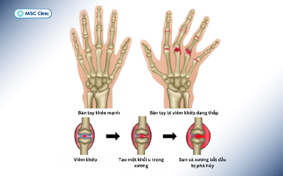 Mô phỏng bàn tay bị viêm khớp dạng thấp gây đau lòng bàn tay