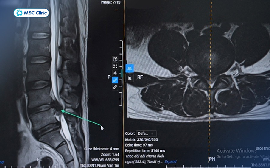 MRI giúp đánh giá chính xác vị trí và mức độ chèn ép rễ thần kinh 