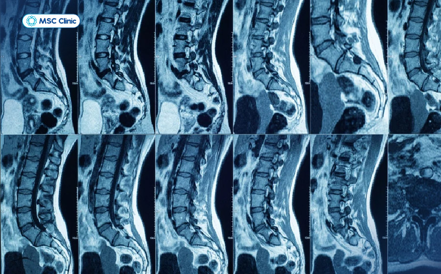 MRI là tiêu chuẩn quan trọng trong đánh giá thoát vị đĩa đệm và tổn thương dây chằng MRI là tiêu chuẩn quan trọng trong đánh giá thoát vị đĩa đệm và tổn thương dây chằng