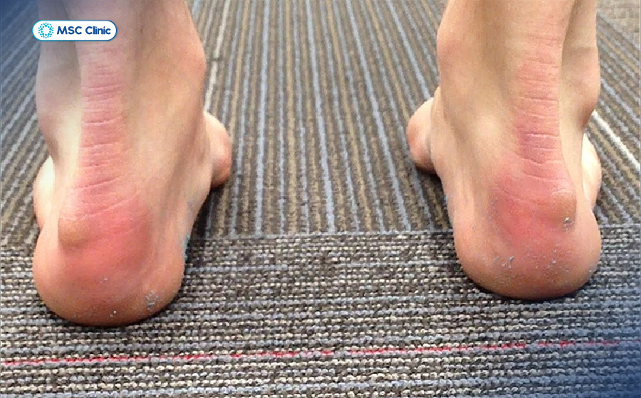 Nếu không được điều trị sớm, viêm gân Achilles kéo dài có thể làm suy yếu cấu trúc gân và tăng nguy cơ rách hoặc đứt gân Nếu không được điều trị sớm, viêm gân Achilles kéo dài có thể làm suy yếu cấu trúc gân và tăng nguy cơ rách hoặc đứt gân
