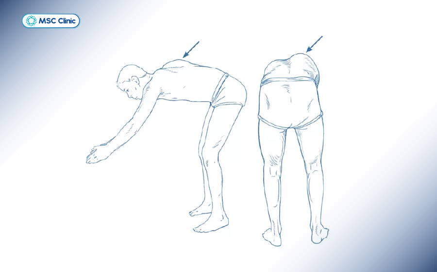 Nghiệm pháp Adam giúp chẩn đoán cong vẹo cột sống
