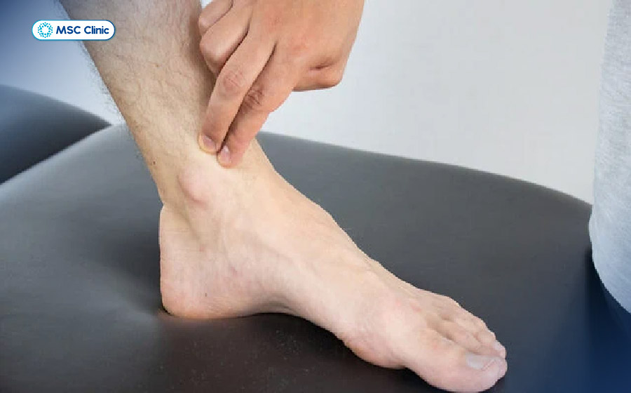 Nghiệm pháp Tinel được sử dụng để phát hiện tình trạng kích thích hoặc chèn ép dây thần kinh chày Nghiệm pháp Tinel được sử dụng để phát hiện tình trạng kích thích hoặc chèn ép dây thần kinh chày