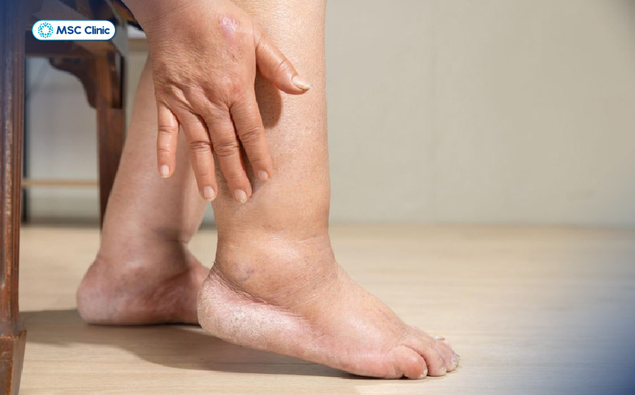 Ngủ dậy bị đau khớp cổ chân có thể là dấu hiệu của cơn gout Ngủ dậy bị đau khớp cổ chân có thể là dấu hiệu của cơn gout