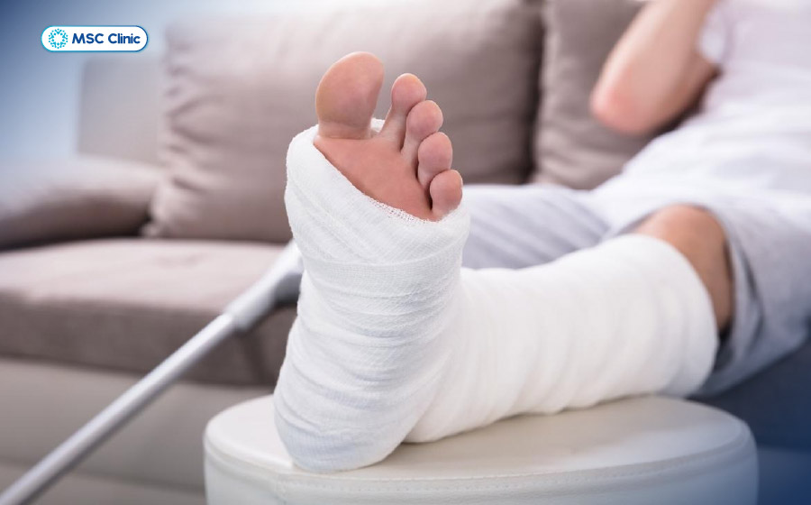 Người bệnh cần phải cố định chân trong một thời gian nhất định để hỗ trợ xương lành đúng vị trí Người bệnh cần phải cố định chân trong một thời gian nhất định để hỗ trợ xương lành đúng vị trí