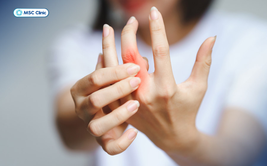 Người bệnh có triệu chứng cứng khớp vào buổi sáng, dấu hiệu của phong thấp Người bệnh có triệu chứng cứng khớp vào buổi sáng, dấu hiệu của phong thấp