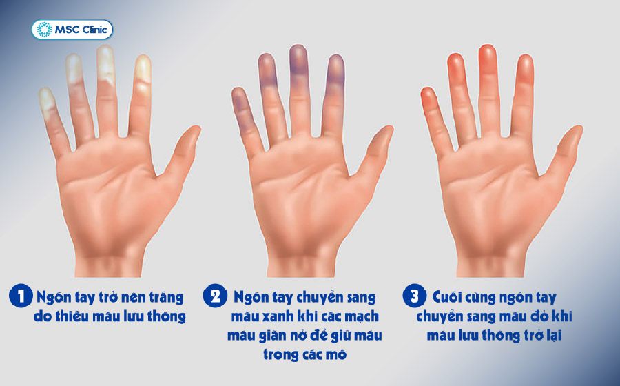 Người mắc hội chứng Raynaud có thể xuất hiện tình trạng đầu ngón tay đổi màu trắng - tím - đỏ kèm tê buốt khi gặp lạnh