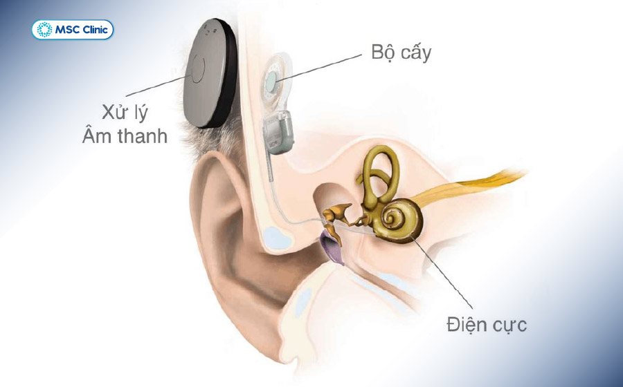 Người sử dụng máy trợ thính cấy ghép tai trong không thể tháo rời chống chỉ định chụp MRI Người sử dụng máy trợ thính cấy ghép tai trong không thể tháo rời chống chỉ định chụp MRI