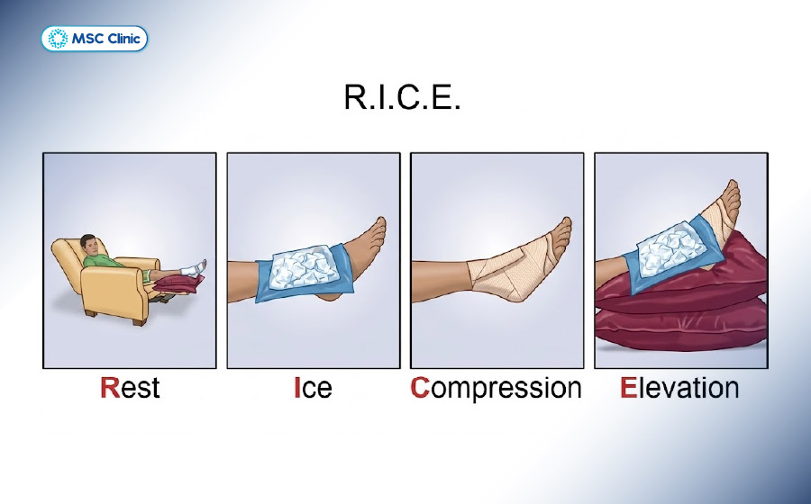 Nguyên tắc R.I.C.E là phương pháp sơ cứu tiêu chuẩn giúp giảm đau sau chấn thương cơ