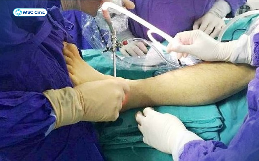 Phẫu thuật giải ép thần kinh có thể được cân nhắc trong những trường hợp chèn ép kéo dài hoặc đáp ứng kém với điều trị bảo tồn Phẫu thuật giải ép thần kinh có thể được cân nhắc trong những trường hợp chèn ép kéo dài hoặc đáp ứng kém với điều trị bảo tồn