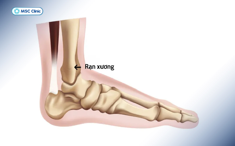 Rạn xương mắt cá chân là tình trạng xuất hiện các vết nứt nhỏ trên xương nhưng chưa gây gãy hoàn toàn Rạn xương mắt cá chân là tình trạng xuất hiện các vết nứt nhỏ trên xương nhưng chưa gây gãy hoàn toàn
