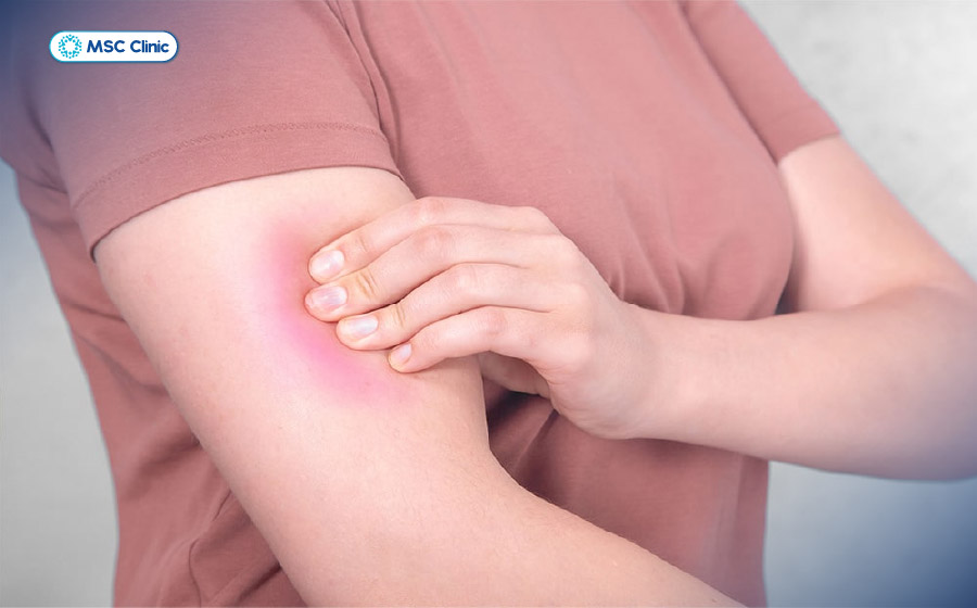 Sưng tấy, bầm tím là dấu hiệu dễ nhận biết khi bị viêm cơ bắp tay