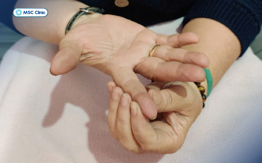 Tê đầu ngón tay khi trời lạnh kéo dài có thể là dấu hiệu cảnh báo của hội chứng Raynaud