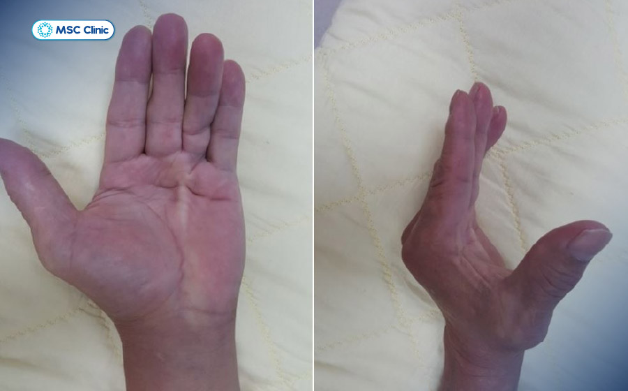 Theo thời gian, các ngón tay có thể co gập vĩnh viễn, gây khó khăn trong việc duỗi thẳng và cầm nắm đồ vật