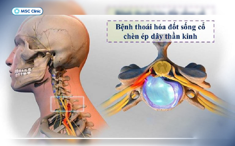 Thoái hóa cột sống cổ gây đau nhức mỏi vùng cổ, vai, gáy