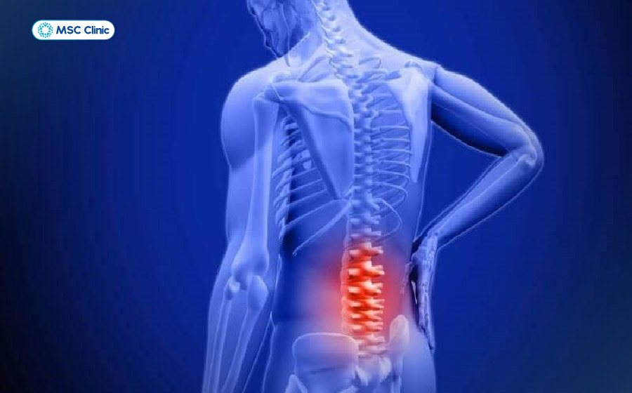 Thoái hóa cột sống thắt lưng có thể gây đau lan xuống vùng xương cụt Thoái hóa cột sống thắt lưng có thể gây đau lan xuống vùng xương cụt