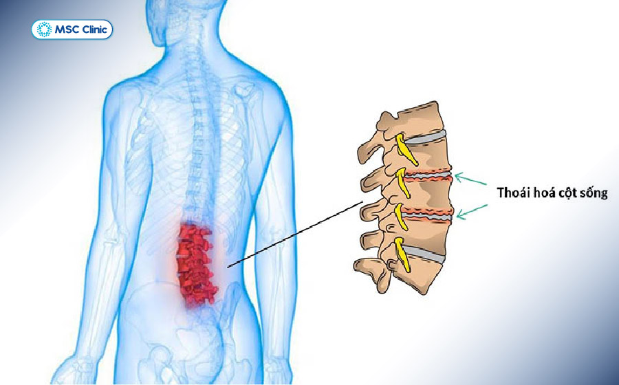 Thoái hóa khiến trục cột sống lệch dần theo thời gian