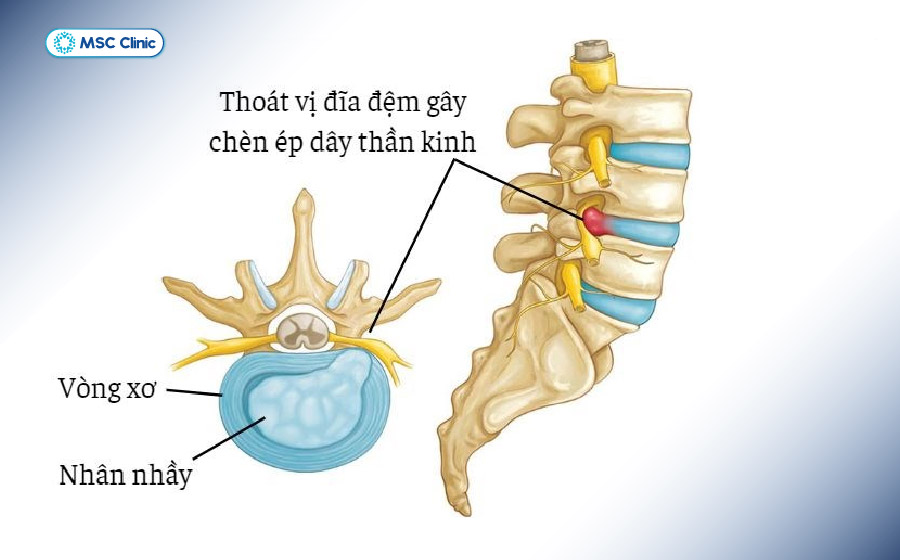 Thoát vị đĩa đệm chèn ép lên dây thần kinh gây đau nhức, tê bì 