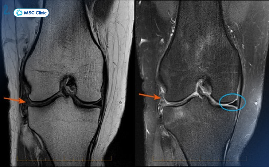 Thông qua hình chụp MRI, bác sĩ có thể thấy rõ các tổn thương cơ xương khớp về dây chằng, sụn chêm khớp gối Thông qua hình chụp MRI, bác sĩ có thể thấy rõ các tổn thương cơ xương khớp về dây chằng, sụn chêm khớp gối