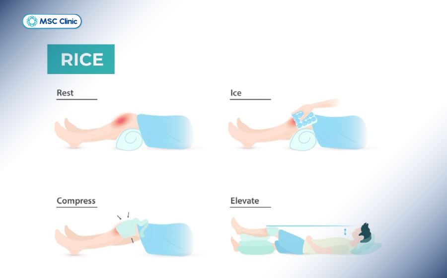 Thực hiện chăm sóc tại nhà theo nguyên tắc RICE Thực hiện chăm sóc tại nhà theo nguyên tắc RICE