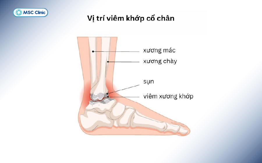 Tình trạng gãy mắt cá chân không được điều trị có thể gây viêm khớp cổ chân Tình trạng gãy mắt cá chân không được điều trị có thể gây viêm khớp cổ chân