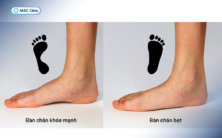 Tình trạng mất vòm bàn chân khiến các cơ và gân phải hoạt động nhiều hơn khi di chuyển, làm tăng nguy cơ căng cơ bàn chân Tình trạng mất vòm bàn chân khiến các cơ và gân phải hoạt động nhiều hơn khi di chuyển, làm tăng nguy cơ căng cơ bàn chân
