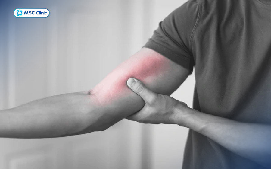 Tình trạng rách cơ tái lại nhiều lần ở cùng một vị trí nên đến thăm khám bác sĩ