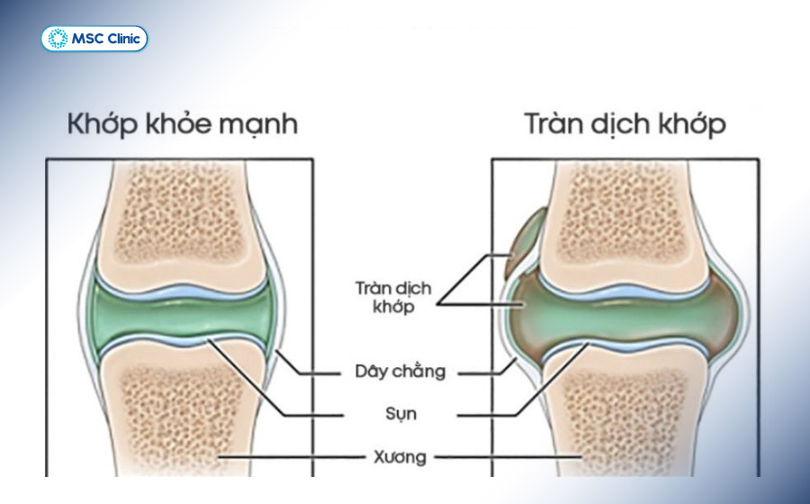 Tràn dịch khớp gối thường là biểu hiện của một nguyên nhân tiềm ẩn bên trong khớp